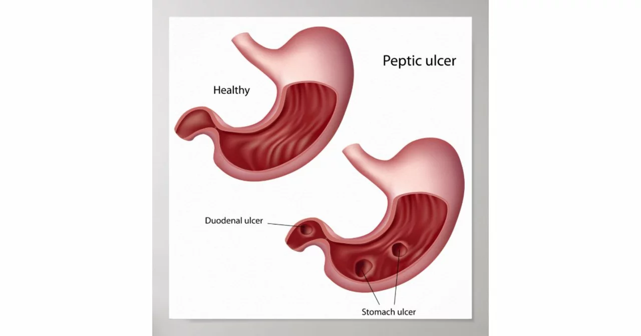 Can Stomach Ulcers Be Cured? Understanding Your Treatment Options